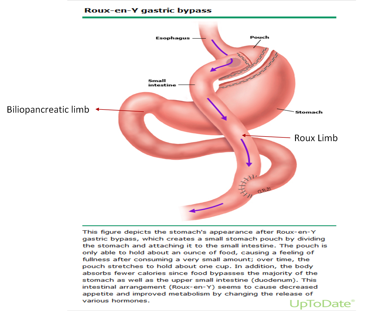 <p><strong>A.</strong> Roux-en-Y bypasses the duodenum and proximal jejunum, leading to malabsorption of iron and calcium, while lap banding preserves normal GI anatomy and absorption<br><br></p>