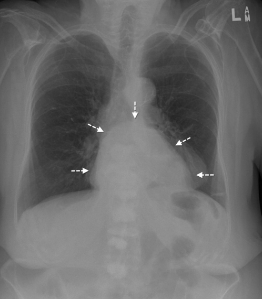 <p><strong>Hiatal hernia</strong></p>