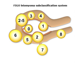 <p><strong>Uterine Fibroids: Management</strong></p><p>-Submucosal fibroids (type 0, 1, 2) → hysteroscopic ____________</p><p>-Fully within muscle wall fibroids type 3-7 → medications or ____________ myomectomy </p><p>-Patients who do not desire future fertility → ____________, uterine artery embolization, endometrial ablation, ______________</p><p>-Patients who desire fertility → ____________</p>