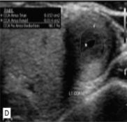 <p>This was seen at the patient’s aorta.&nbsp;</p><ol><li><p>How does it appear sonographically?</p></li><li><p>What pathology can be assumed here?</p></li></ol><p></p>