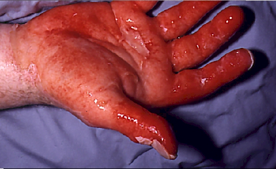 <p>2nd degree burn-Causes </p>