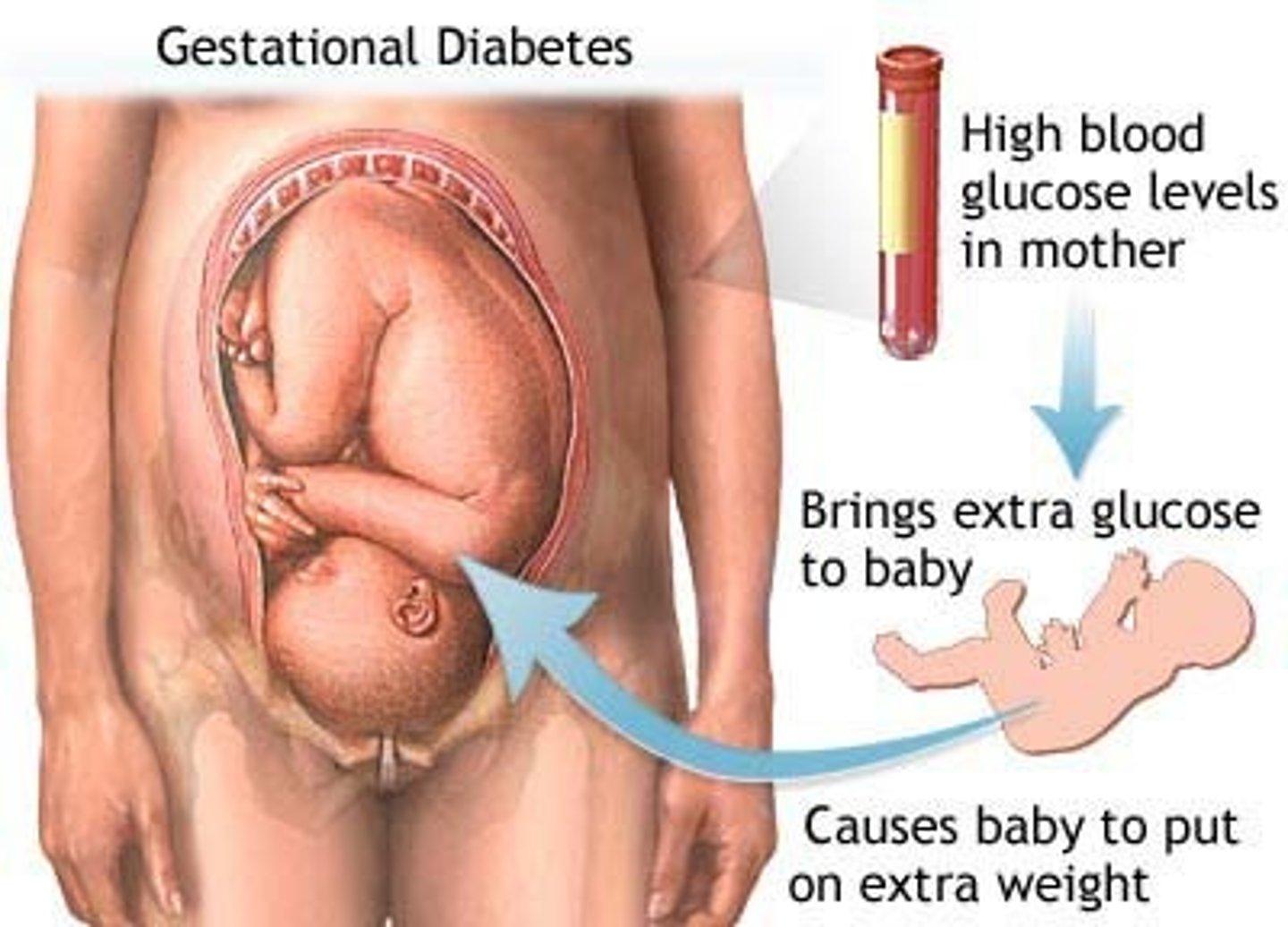 <p>Pregnancy - hormones block insulin production - bad blood sugar level</p>