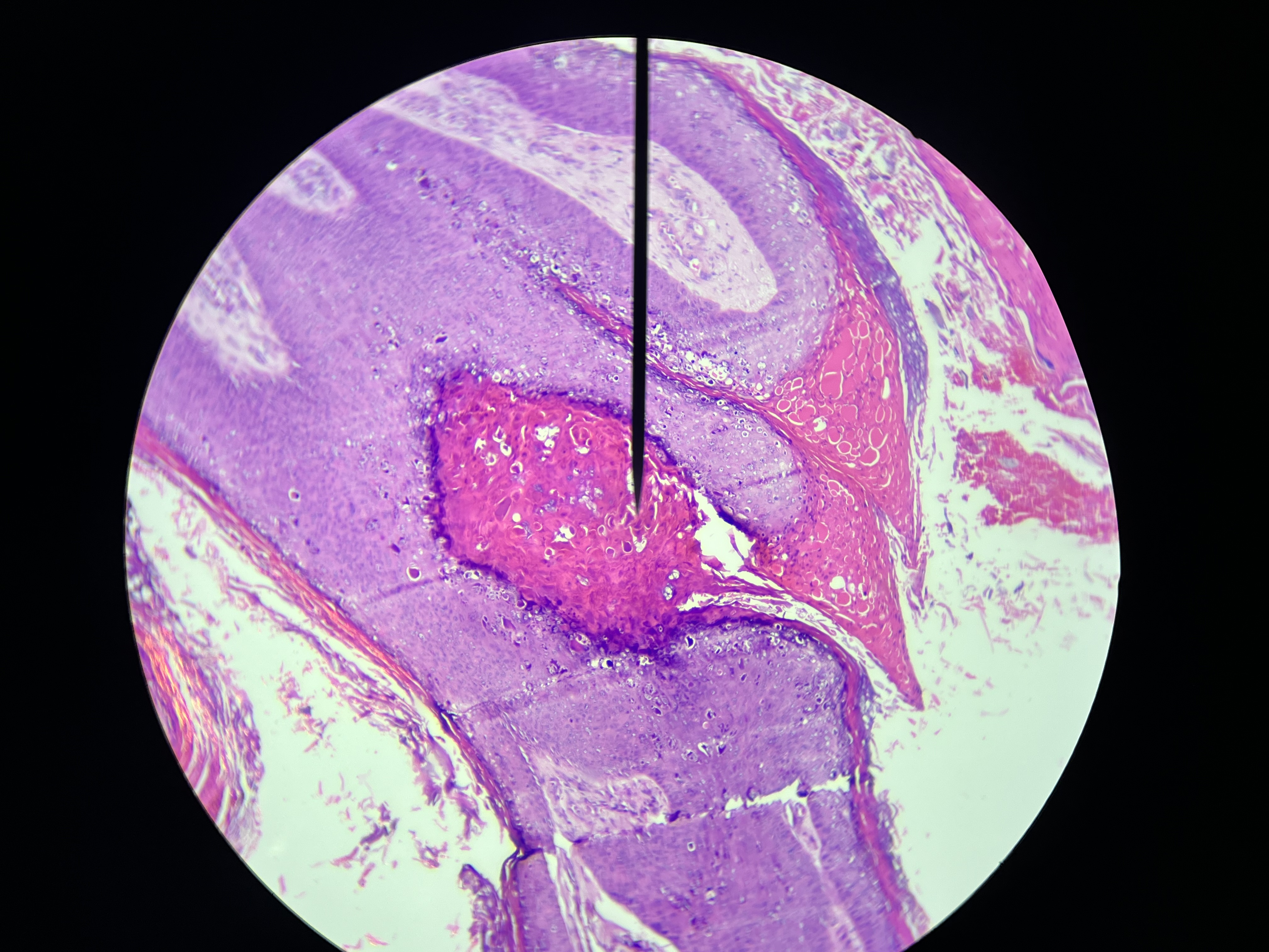 <p>A viral skin infection caused by the Molluscum contagiosum virus, characterized by small, raised, painless bumps on the skin that can spread through direct contact. </p>