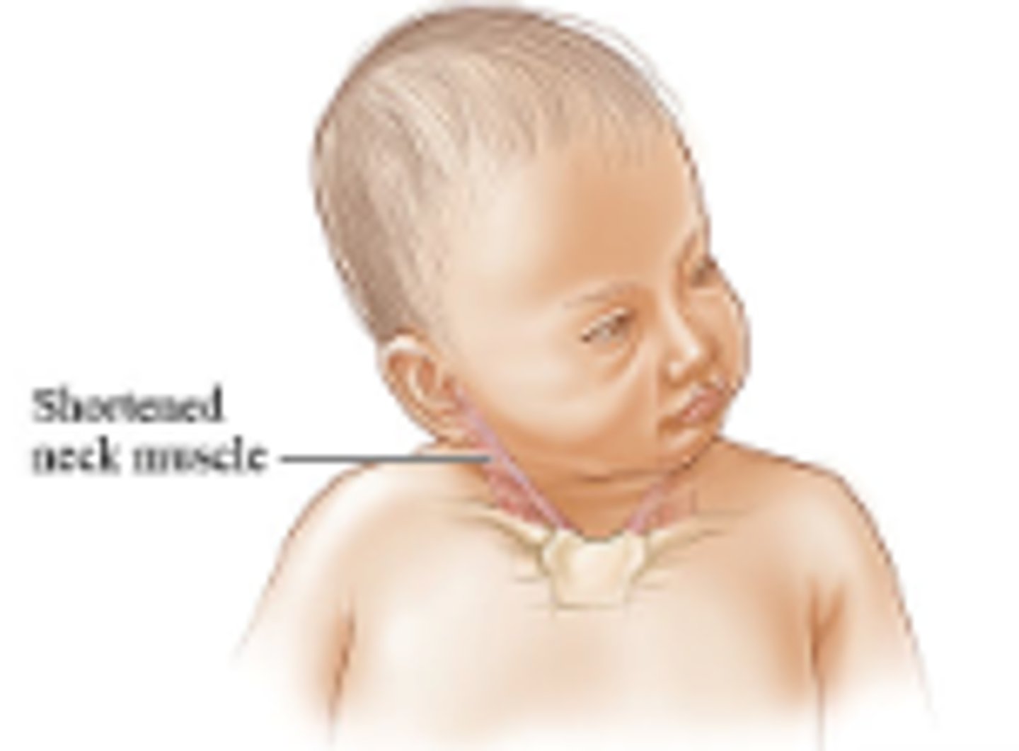 <p>result of difficulty in delivery of baby - use of forceps usually</p><p>- treatment with a surgical release of the SCM from the origin and repair</p>