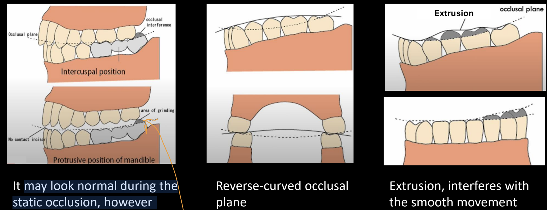 <p>protrusive mandible (caused by occlusal interference), reverse-curved occlusal plane- upward, extrusion</p>