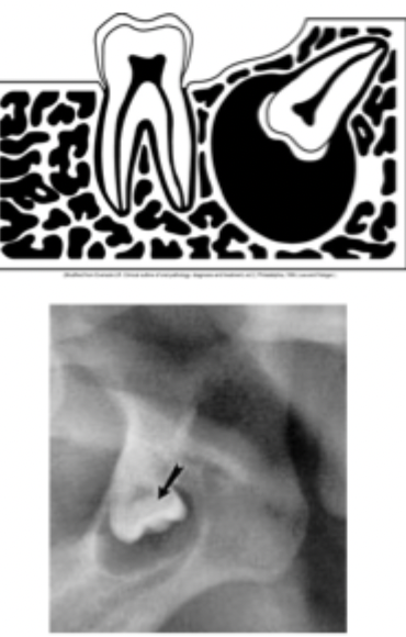 <p>area around the crown of an impacted tooth (common- mand 8’s) </p>