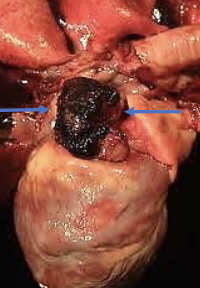 <p>malignant tumor arising from endothelial cells (blood vessels)</p>