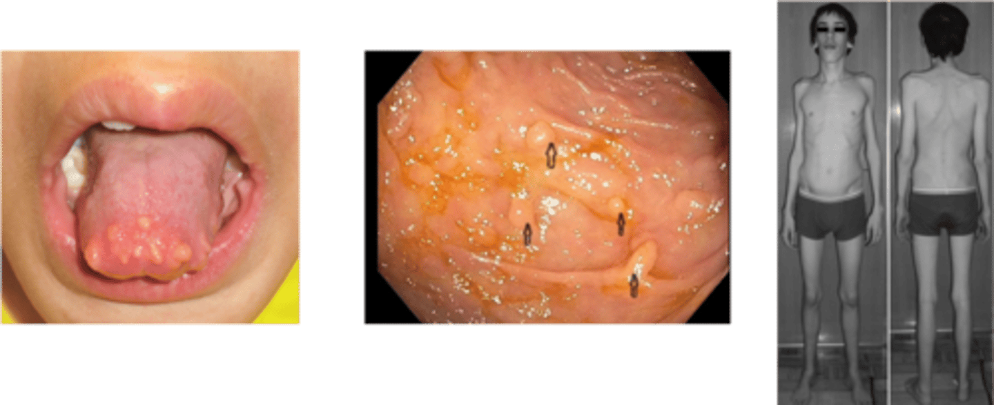 <p>Define Condition:</p><p>Hereditary Cancer Syndromes a/w multiple endocrine tumors</p><p>-Hx: AUTOSOMAL DOMINANT</p><p>&gt; Most who have MEN2 = MEN2A (only 5% have MEN2B)</p><p>&gt; Appears around 30 y/o</p><p>-Path: </p><p>&gt; D/t gain-of-function mutation to RET proto-oncogene on chromosome 10 (encodes TK receptor playing role in cell growth)</p><p>&gt; MEN2A</p><p>&gt;&gt; 1st = Medullary Thyroid Carcinoma</p><p>&gt;&gt; Parathyroid hyperplasia</p><p>&gt;&gt; Pheochromocytoma</p><p>&gt; MEN2B</p><p>&gt;&gt; 1st = Medullary Thyroid Carcinoma</p><p>&gt;&gt; Pheochromocytoma</p><p>&gt;&gt; Non-endocrine = mucosal neuroma, intestinal ganglioneuromas, marfanoid habitus</p>