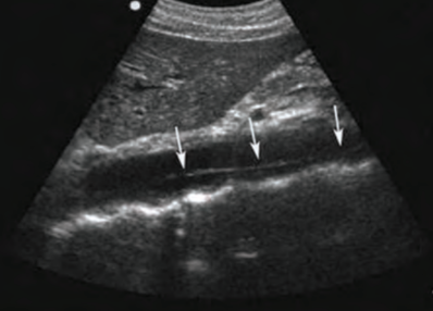 <ul><li><p>blood splits the tunica walls, causing them to separate —> blood leakage between walls</p></li><li><p>SONO: echogenic line running down the center of AO</p></li></ul><p></p>