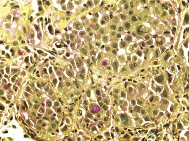 <p>Patrón de adenocarcinoma</p>