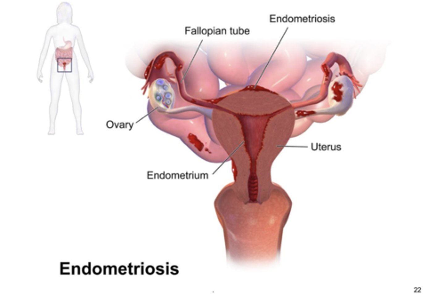 <p>endometrial tissue occurs outside the uterus and ectopic endometrium responds to cyclical hormone changes. bleeding leads to inflammation and pain, fibrous tissue can cause adhesions and obstructions of the involved. treated with hormonal suppression and surgical removal of ectopic tissue</p>