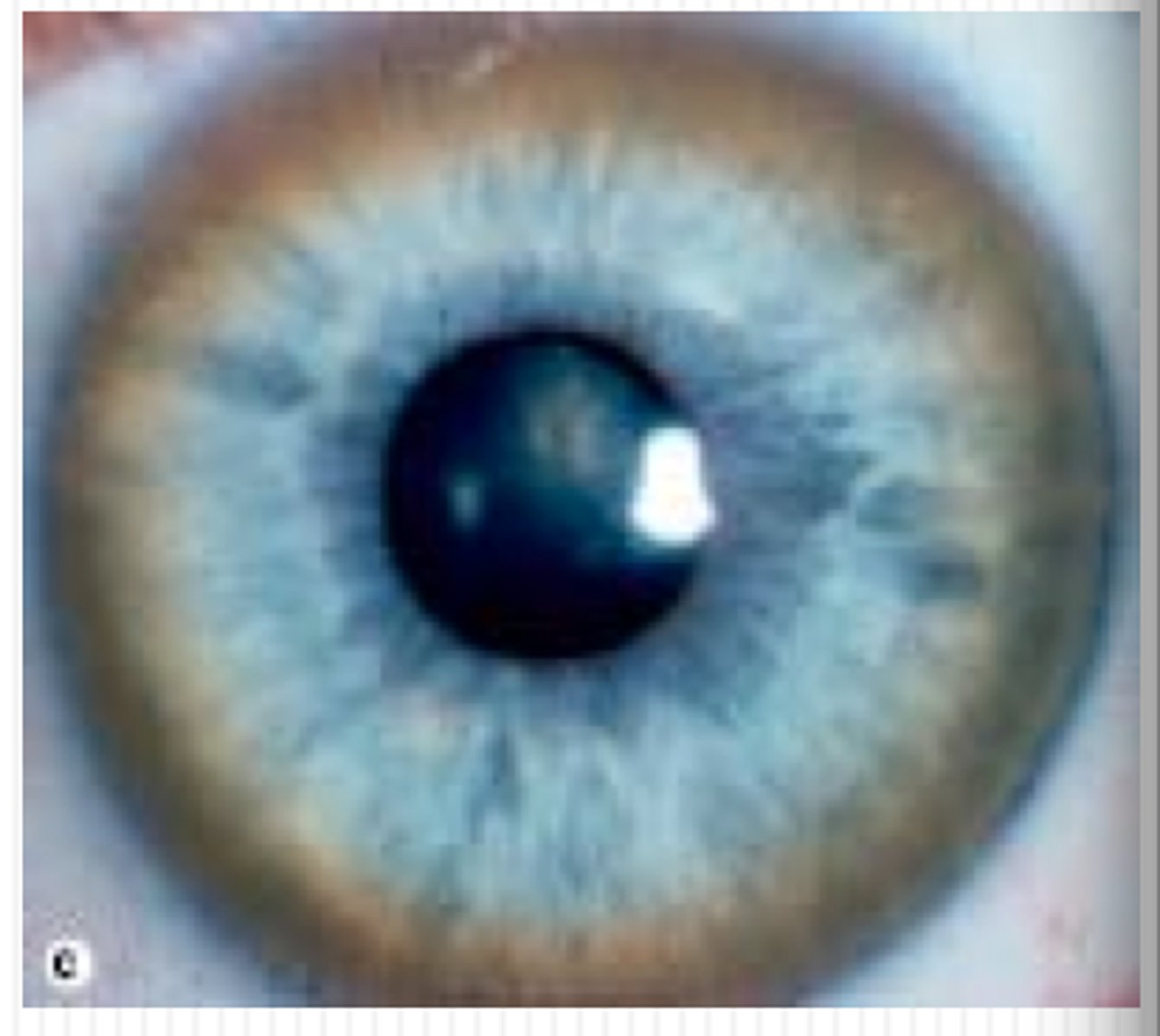 <p>Kayser-Fleischer rings (copper accumulation from Wilson disease, check ceruloplasmin)</p><p>Risk of basal Ganglia atrophy</p>