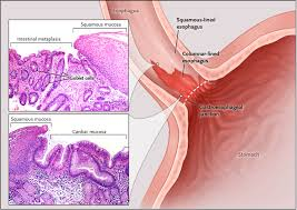 <p>How do you identify Intestinal Metaplasia (Barrett's Oesophagus)? </p>