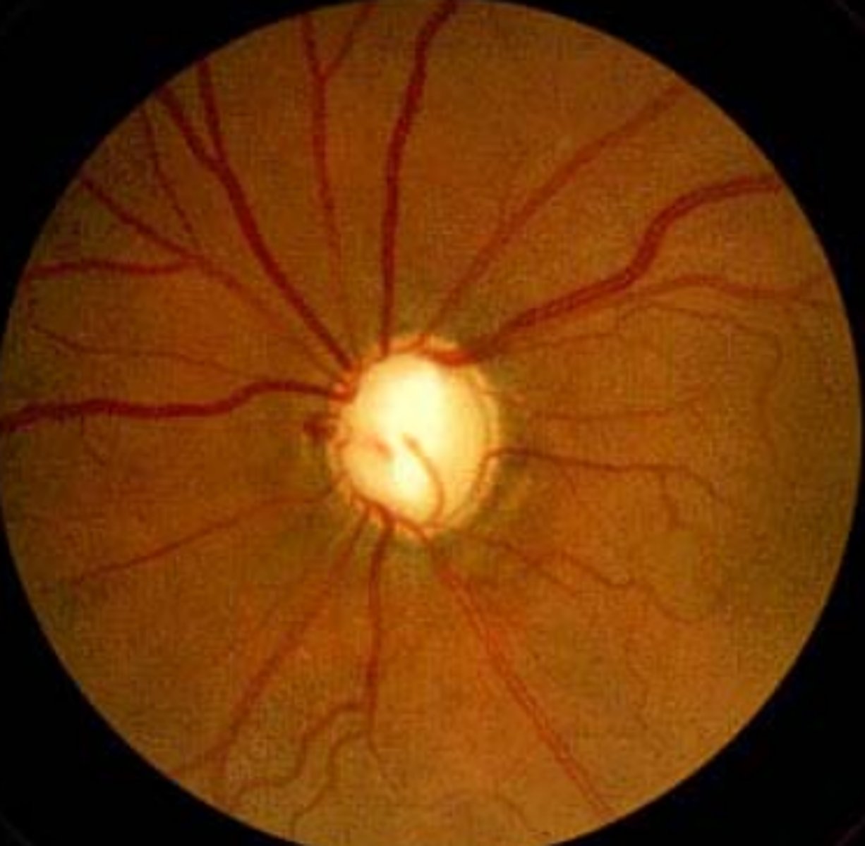 <p>Information for Condition:</p><p>-Caused by increased intraocular pressure (leads to optic nerve damage and visual field changes)</p><p>-Aqueous humor produced by ciliary body goes from posterior to anterior chamber</p><p>-Open Angle Vs Angle Closure</p><p>Can damage optic nerve (see increased cupping of disc, atrophy of ganglion cell layer of retina, aka "Glaucomatous Retinal Degeneration" &amp; atrophy of nerve)</p>