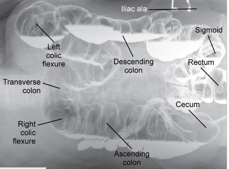 <p>Barium Enema: Identify the Position</p>