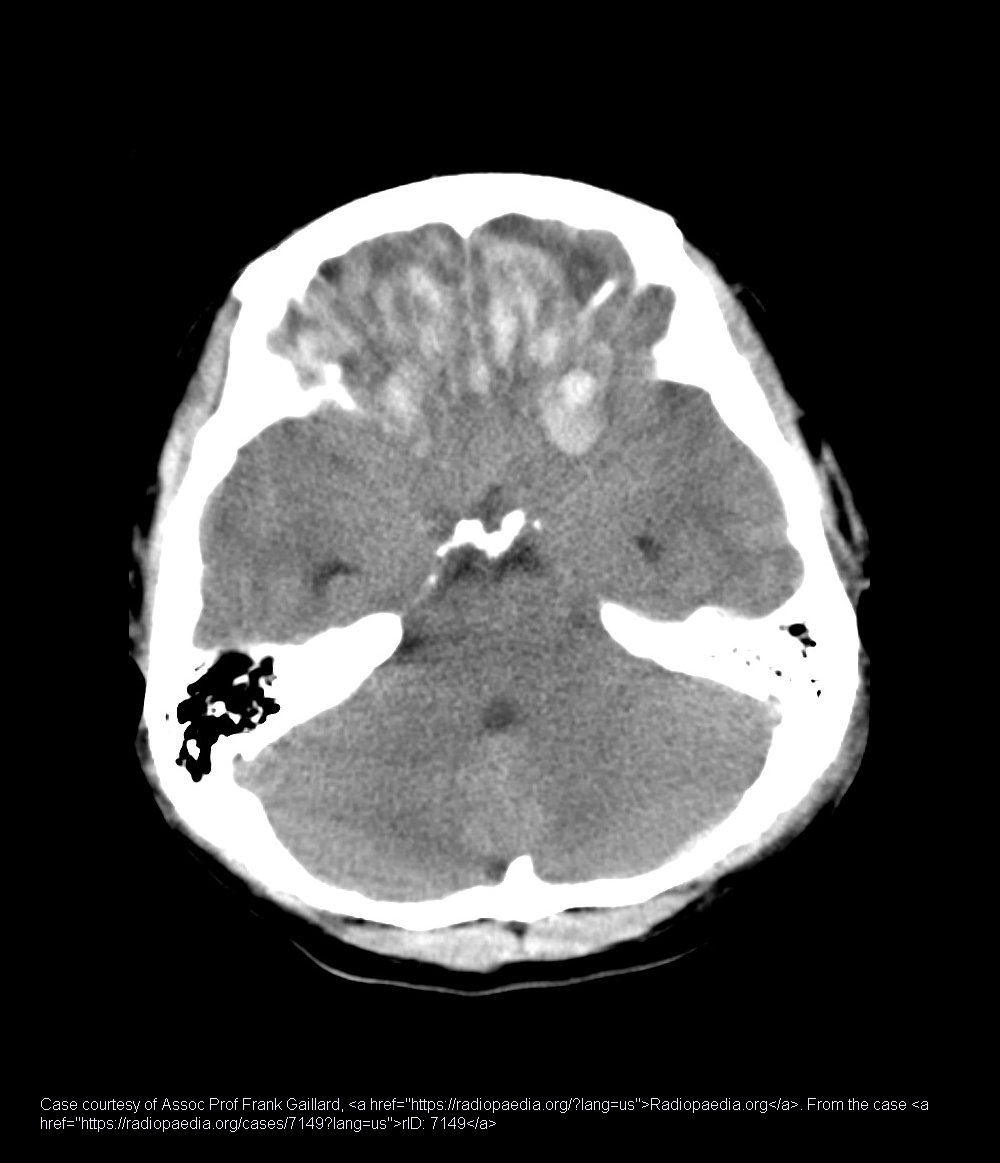 <p>Micro-hemorrhages in brain tissue, often from coup-contrecoup injuries.</p>