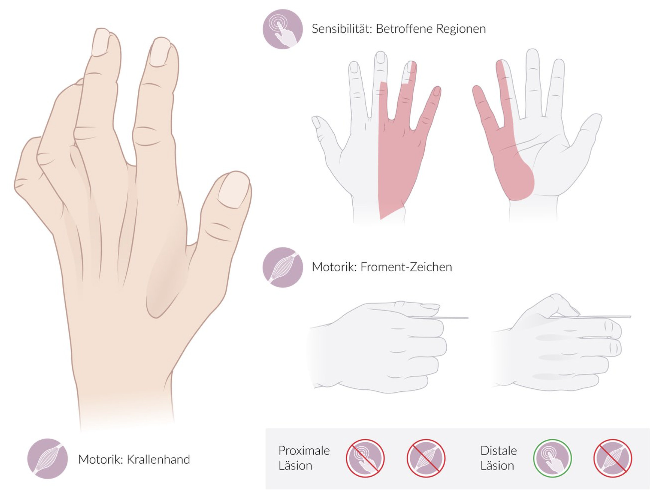 <p>E. Hyperextension of the finger base joints with flexion of the middle and end joints (= claw hand)</p>