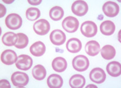 <ul><li><p>leptocyte with central area of pigment </p></li><li><p>surrounded by clear area &amp; ring of peripheral cytoplasm</p></li><li><p>resemble target/bullseye </p></li><li><p>associated with anemia, liver dz, inherited disorders </p></li></ul><p></p>