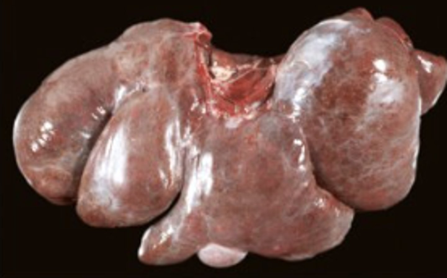 <p>What has caused this gross appearance of this liver?</p>