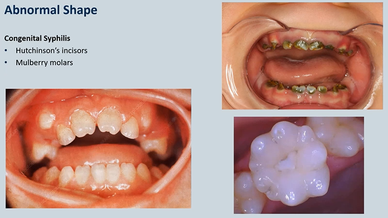 <p><strong>congenital Syphilis → vertically transmitted from the mother </strong></p><ul><li><p>Hutchinson’s incisors </p></li><li><p>Mulberry molars</p></li></ul><p></p>