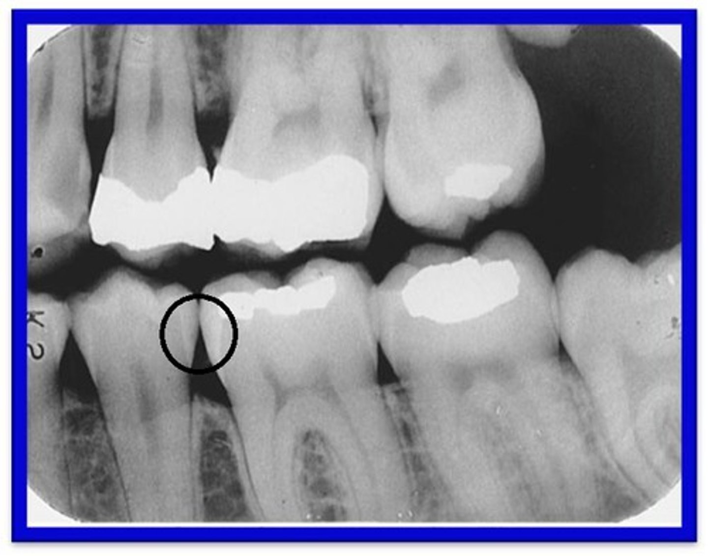 <p>Extends <strong>more than halfway</strong> through enamel but does not involve the DEJ. Class II </p>