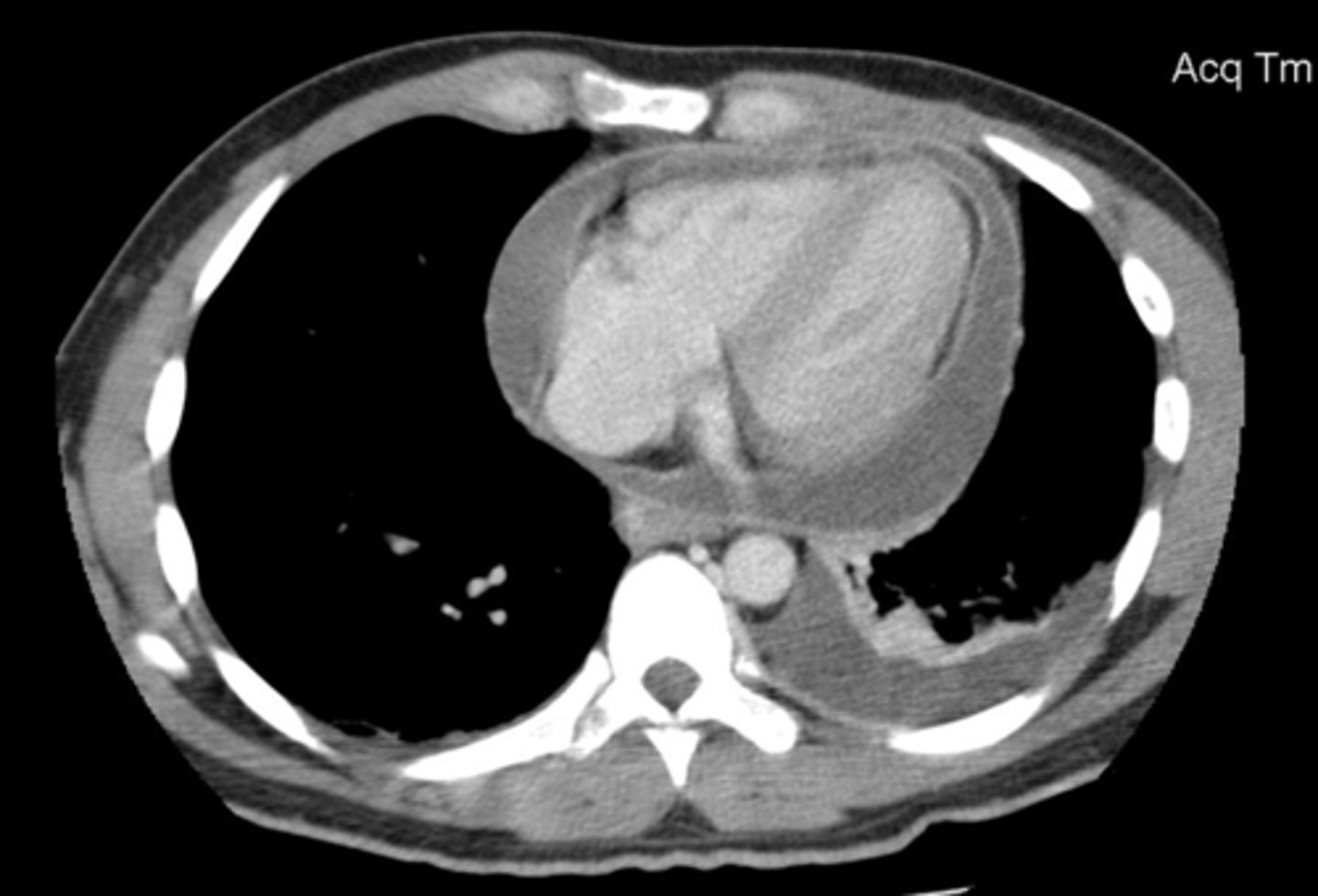 <p>accumulation of fluid in the pericardial cavity</p>