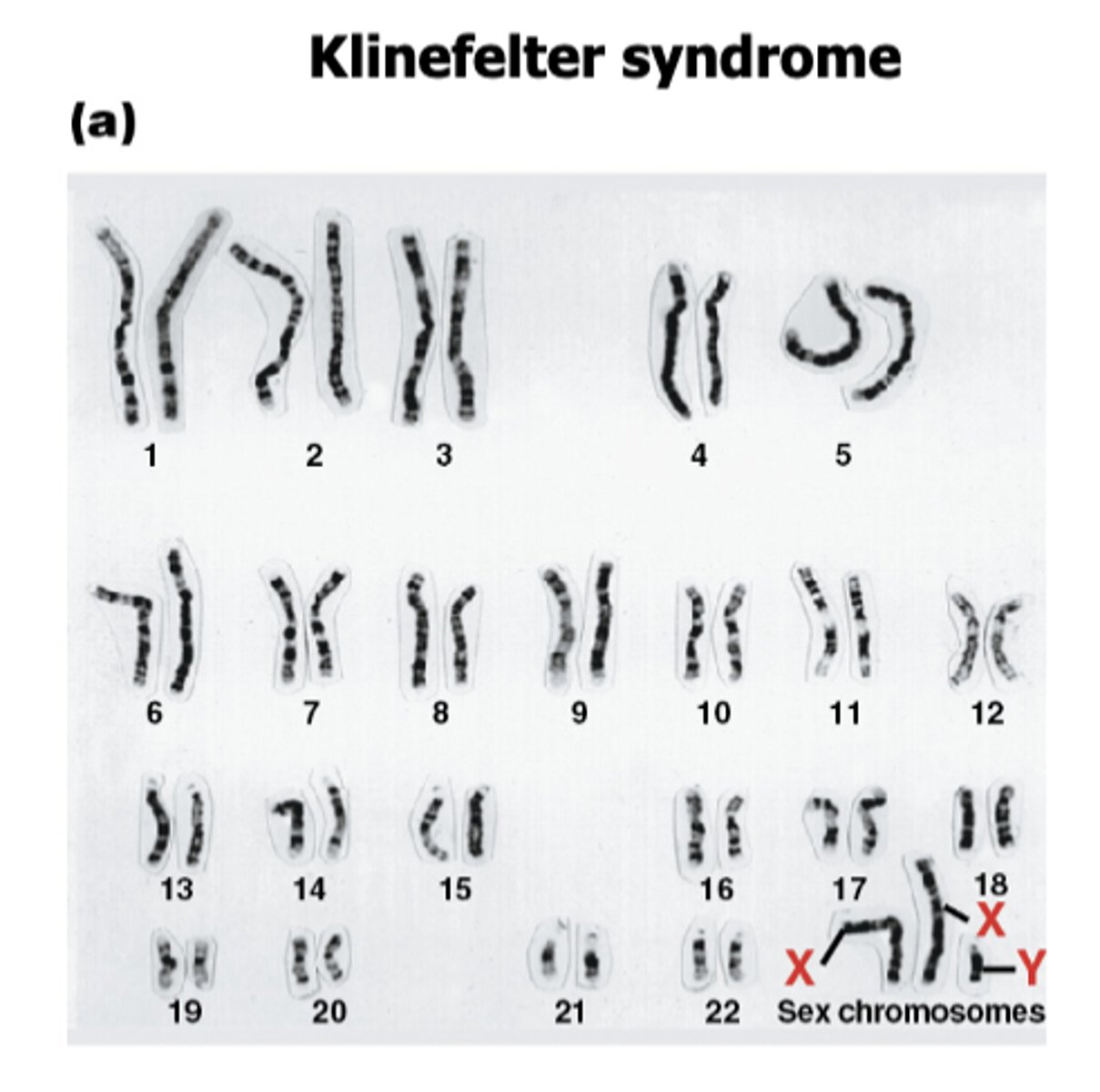 <p>XXY or a 47,XXY, 48,XXXY, 49,XXXXY karyotype</p>
