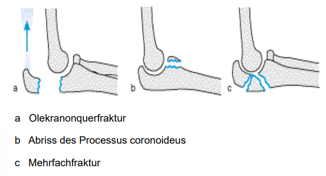 <p>a) Olekranonquerfraktur - ohne OP nicht heilbar</p><p>b) Abriss des Processus coronoideus - kann man konservativ behandeln, kommt auf größe an</p><p>c) Mehrfachfraktur - operativ</p>