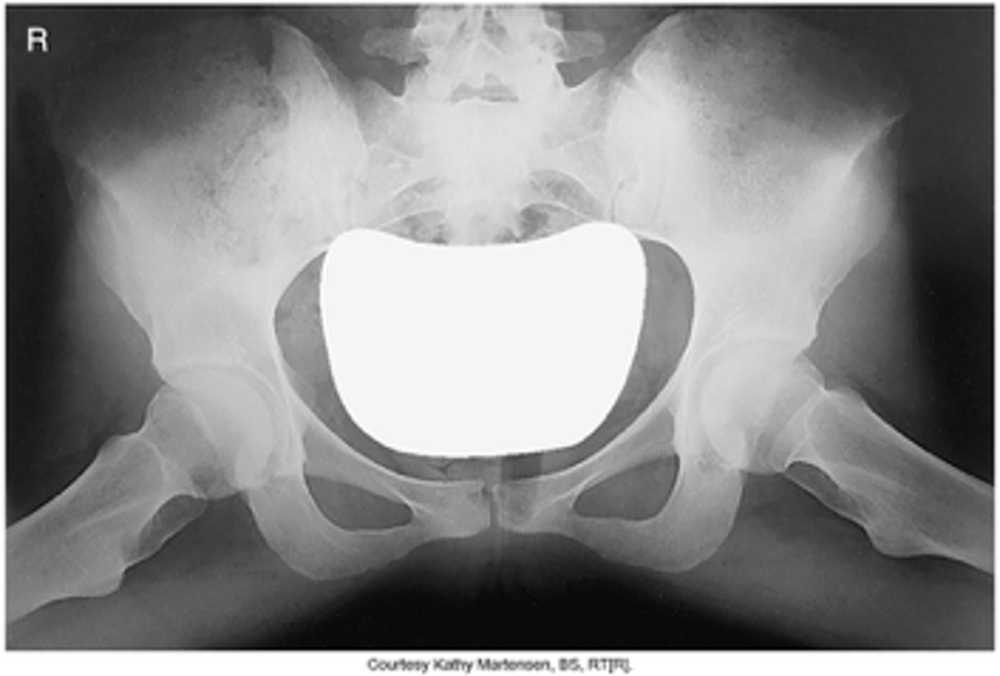<p>- Abduct femora 40° to 45°</p><p>- CR 3 inches (7.5 cm) below level of ASIS</p><p>- 20° to 30° abduction—less distortion of femoral neck</p><p>- Pelvic girdle centered horizontally</p><p>- No rotation of pelvis</p><p>- Lesser trochanters equal in size</p><p>- Greater trochanters superimposed over femoral neck</p><p>- Optimal exposure factors</p>