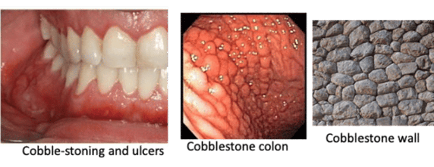 <p>____________ is an inflammatory bowel disease (IBD) characterized by bouts of abdominal pain, diarrhea, weight loss, nutritional deficiencies due to lesions involving anywhere in the GI tract, including oral cavity</p>