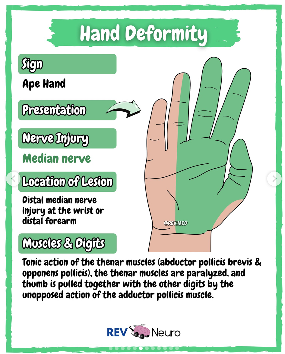<p>(distal median nerve)</p><p>-Motor loss of lumbricals I and II (MCP flexion digit II and III), opponens pollicis, abductor pollicis brevis, flexor pollicis brevis<br>-flattening of the thenar eminence <br>-loss of thumb opposition<br><br>OT int: C-bar splint with thumb in opposition</p><p>Post surgery- splinting, ROM/tendon gliding when cleared</p>
