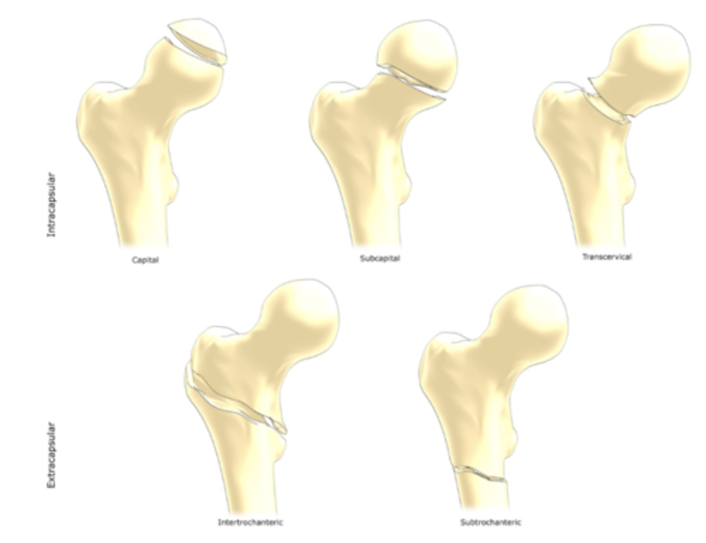 <p>Subcapital neck</p><p>Transcervical neck</p><p>Intertrochanteric</p><p>Subtrochanteric</p><p>Fx of greater trochanter</p><p>Fx of lesser trochanter</p>