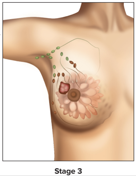 <ul><li><p>Tumor is larger and moved out of originating tissues, but not to distant organs</p></li><li><p>Cancer cells detectable in lymph node tissues</p></li></ul>