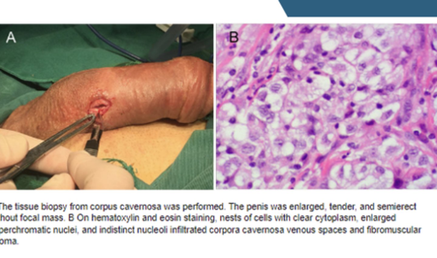 <p>Biopsy (gold-standard), may need ultrasound-guided fine needle aspiration of the inguinal lymph nodes if they're involved</p>