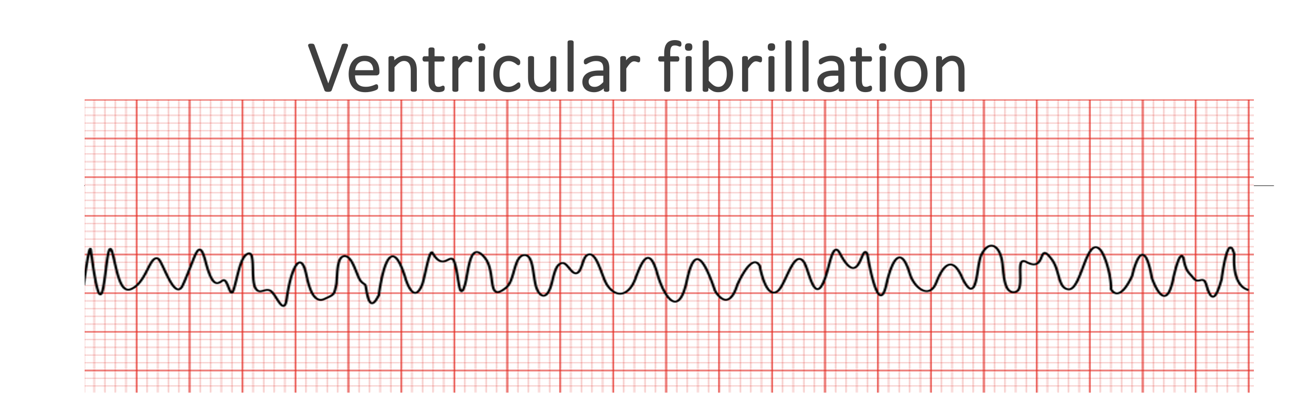 <p>Ventricular fibrillation </p>
