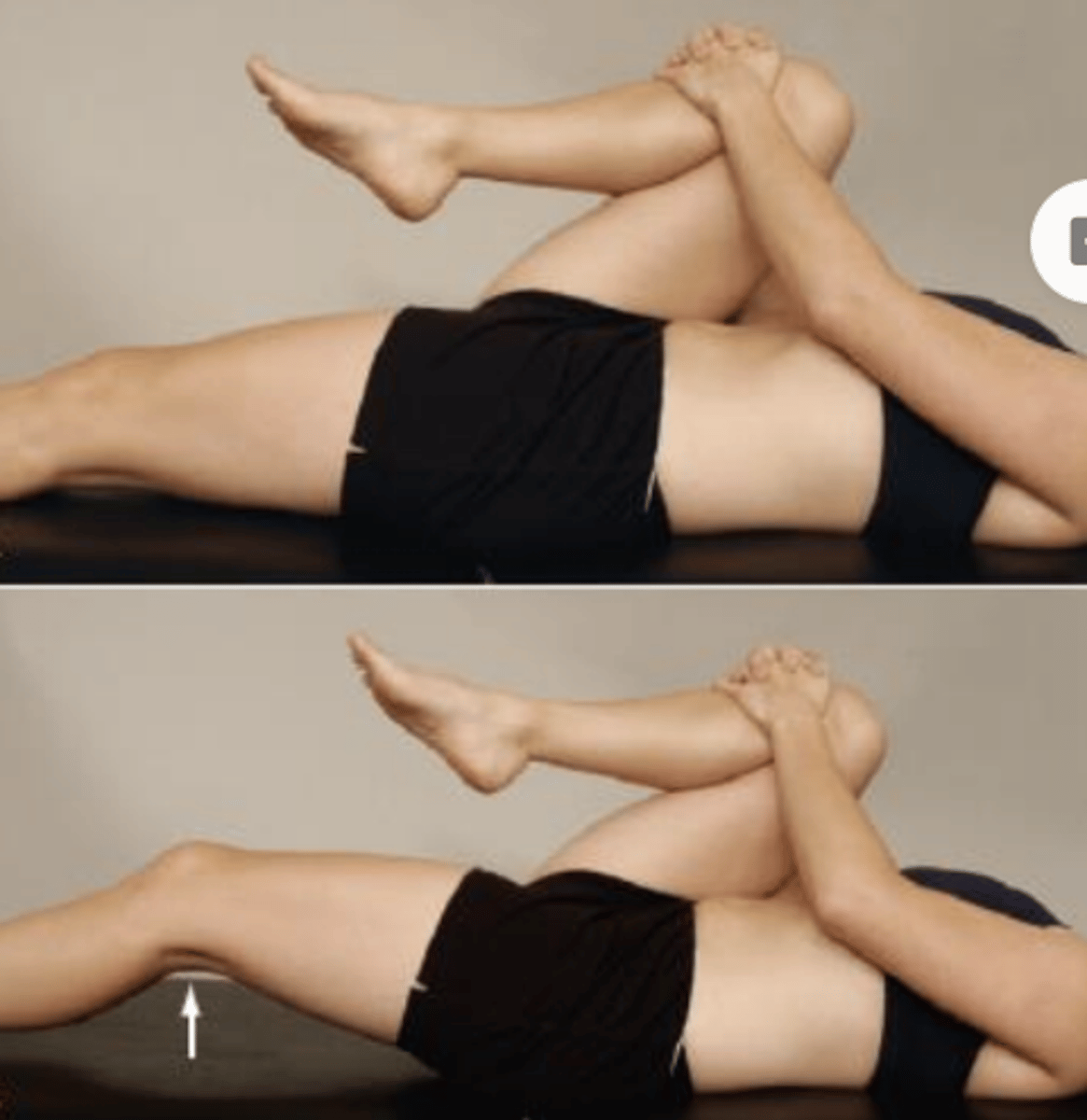 <p>- tightness of hip flexors</p><p>Procedure:</p><p>- The patient lies supine while the examiner checks for excessive lordosis, which is usually present with tight hip flexors. The examiner flexes one of the patient's hips, bringing the knee to the chest to flatten out the lumbar spine and to stabilize the pelvis. The patient holds the flexed hip against the chest.</p><p>(+): If there is no flexion contracture, the hip being tested (the straight leg) remains on the examining table. If a contracture is present, the patient's straight leg rises off the table and a muscle stretch end feel will be felt</p><p>***<span style="background-color: transparent;">The Thomas test screens for hip flexor tightness. The iliopsoas is a one-joint hip flexor; when it is tight, the test-side thigh cannot reach the table and rises into hip flexion. Because the knee remains at 90° of flexion, the rectus femoris (a two-joint muscle that flexes the hip and extends the knee) is of adequate length. The combination of thigh lift-off with the knee staying at 90° localizes the restriction to a one-joint hip flexor, the iliopsoas. B. A two-joint hip flexor (rectus femoris): tightness here would additionally pull the knee into extension; since the knee remains at 90</span></p>