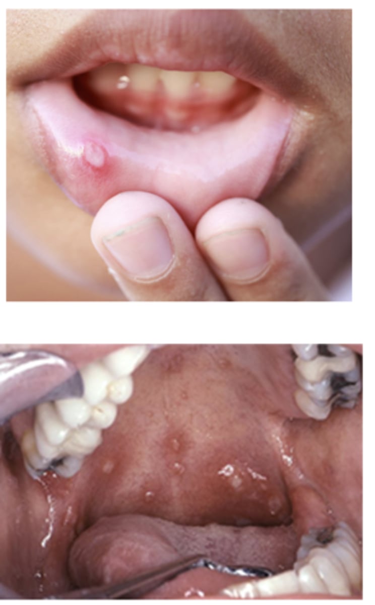 <p>Aphthous Stomatitis (ulcers) can present in what GI conditions?</p>