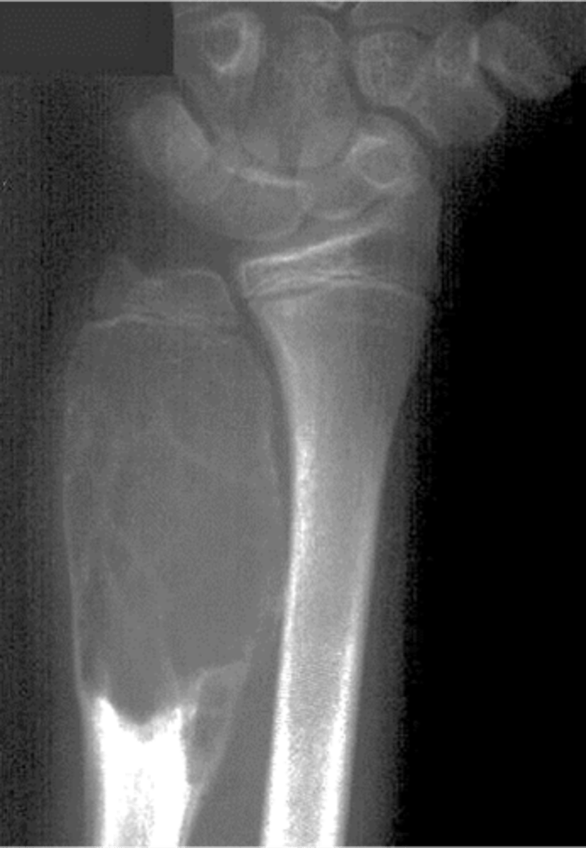 <p>- 1% of biopsied primary bone tumors</p><p>- M:F, 2:3</p><p>- 5-20 y.o.</p><p>- Acute pain</p><p>- Previous trauma</p><p>- 80% tubular bones and spine</p>