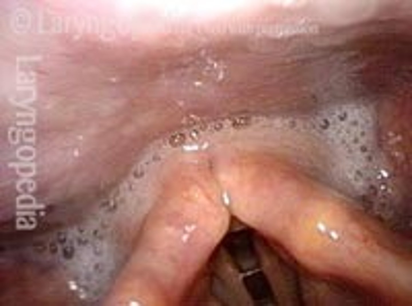 <p>Secretions pooling in the pyriform sinus</p>