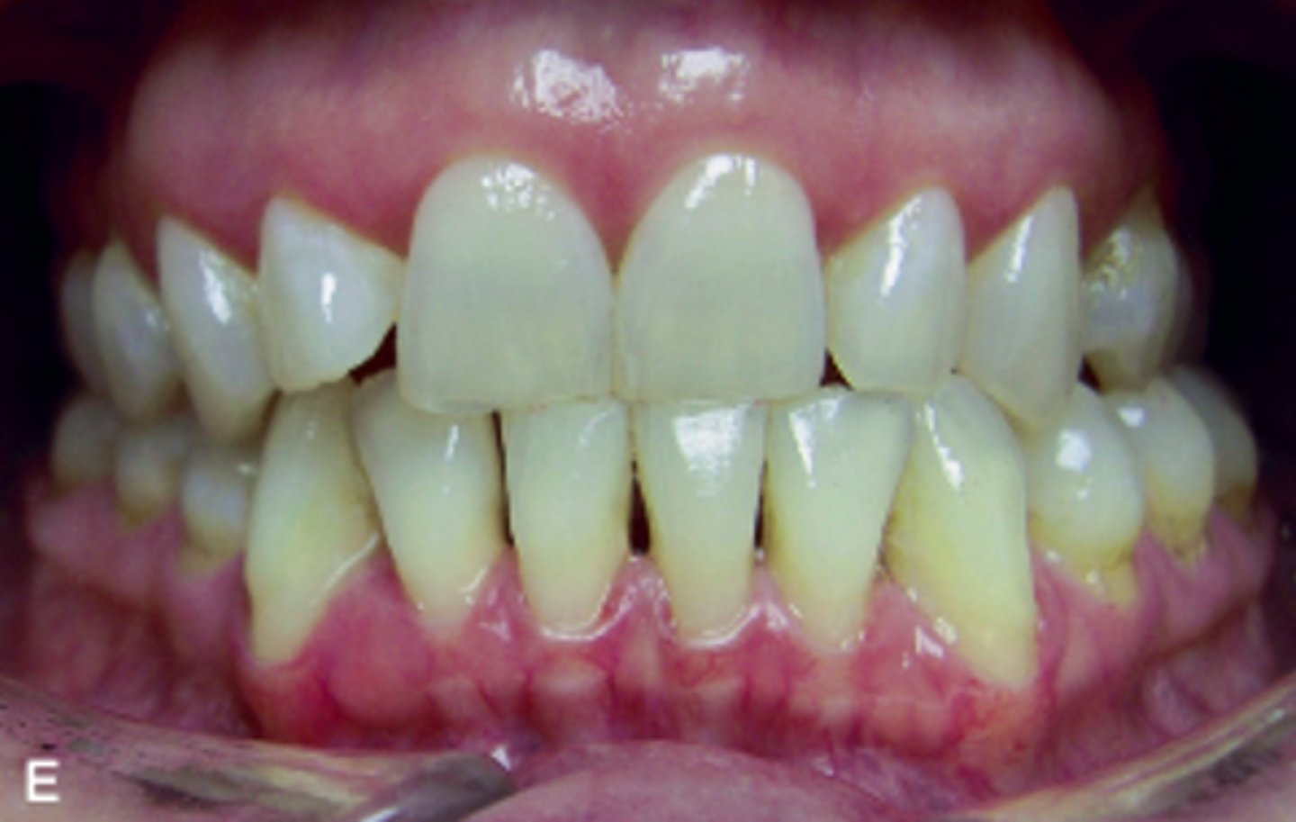 <p>ID the occlusion classification:</p>