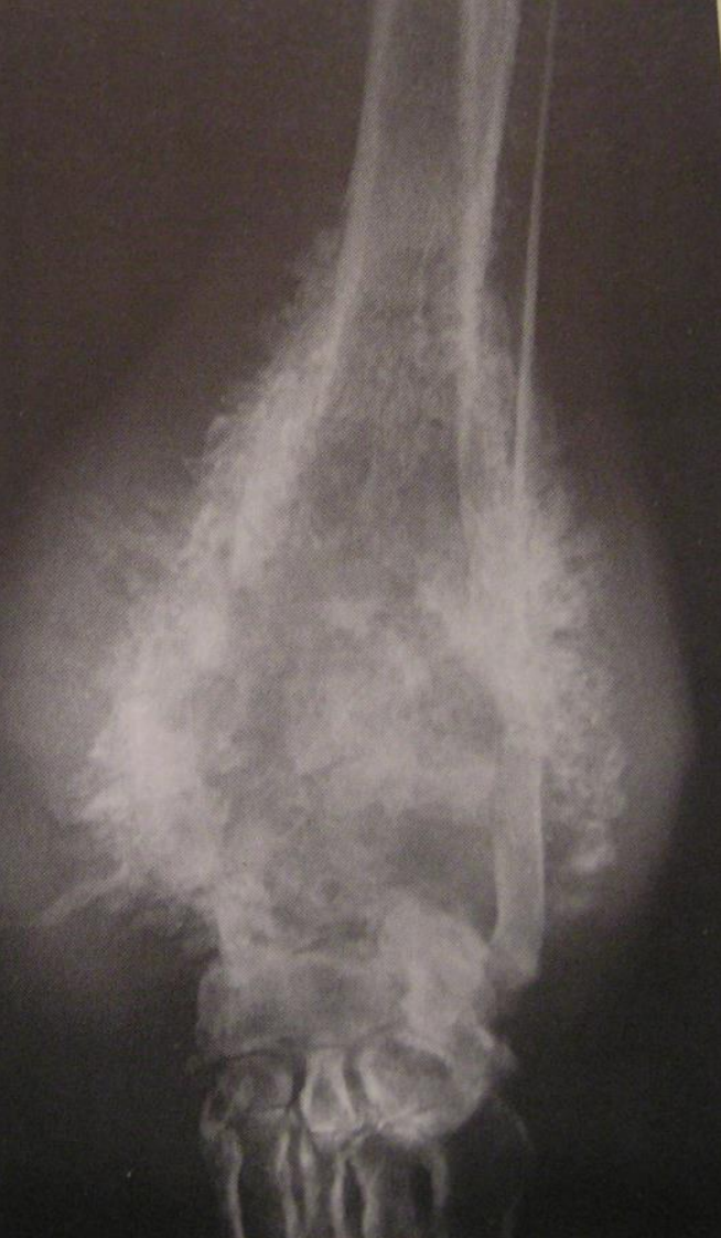 <ul><li><p><span style="color: red">Sunburst and disorganized aggressive perosteal reaction </span>on femur.</p></li><li><p>in second picture, we can see a very aggressive sunburst reaction. </p></li></ul><p></p>