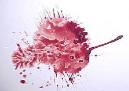 <p>A bloodstain pattern that is caused by a low velocity impact/force to a blood source. Large stains (4mm or greater)</p>