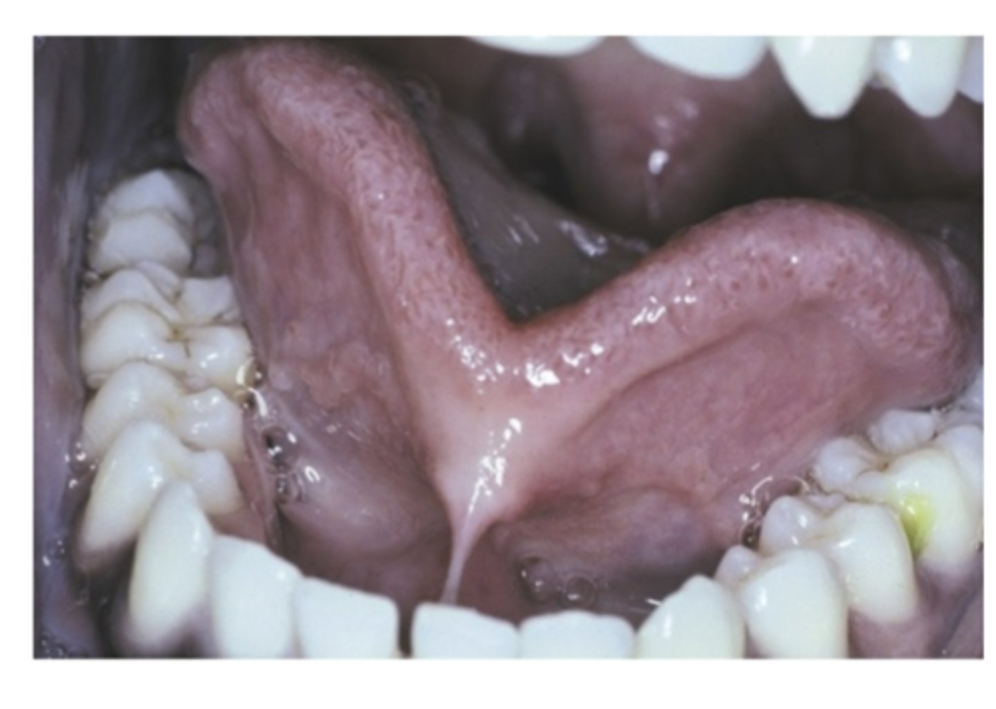 <p>What is Ankyloglossia? what is it caused by? What sex is more affected? </p>
