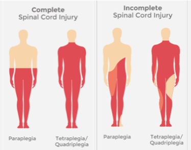 <p><span><span>Paraplégie.</span></span></p>