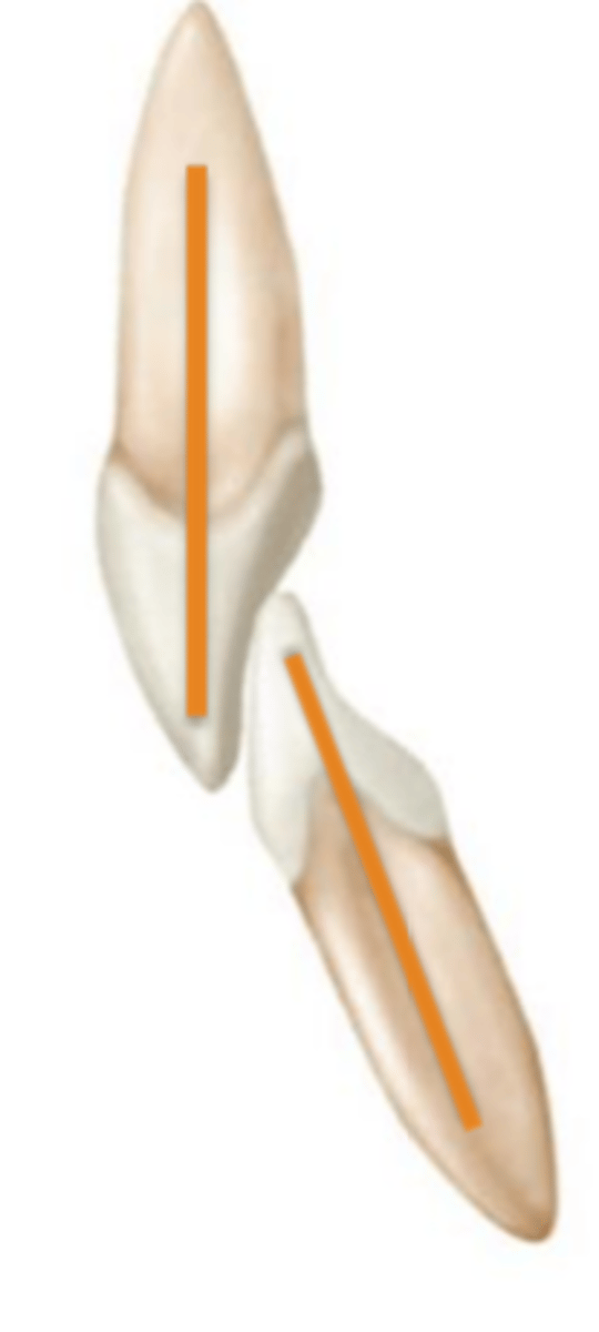 <p>B) class II molars relation with lingual inclination of the incisors</p>