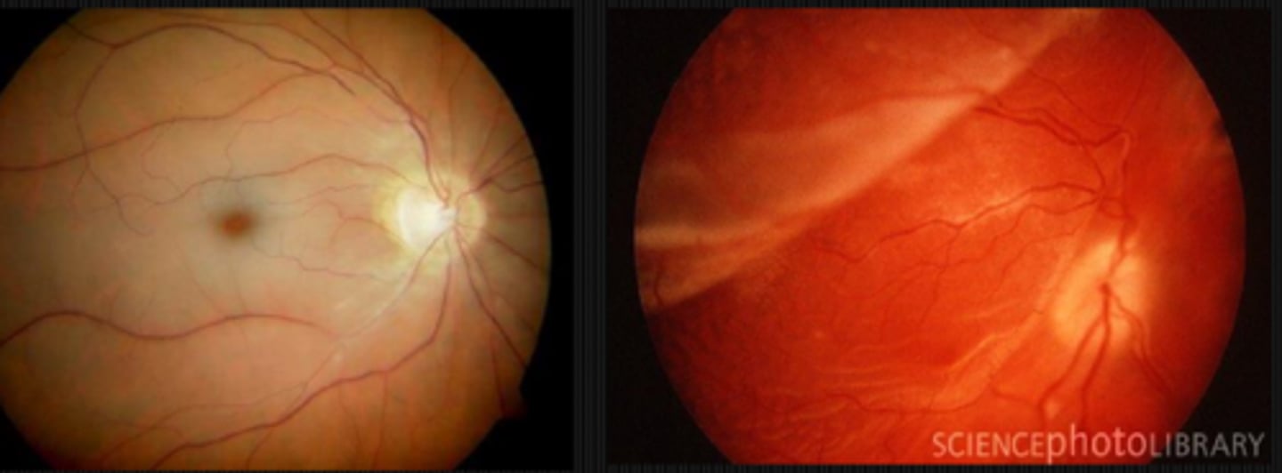 <p>CRA occlusion</p><p>RD</p>