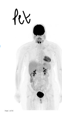 <ul><li><p>Computerised Tomography <strong>CT</strong> - 3D image using X-ray of chosen area</p></li><li><p>positron emission tomography <strong>PET</strong> - patient injected with radio-labelled fluorodeoxy<span style="color: purple;"><strong>glucose</strong></span> 18F-FDG to identify metabolically active areas of the body (cancer cells as they will use up more glucose then other cells)</p></li><li><p>PET-CT combination</p></li></ul><p></p>