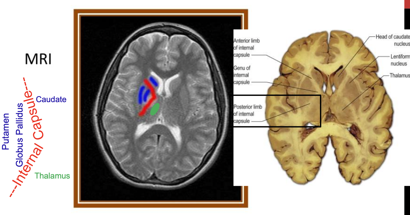 <p>first, CST descends through the <strong><em>internal capsule</em></strong> in the <strong><em>posterior limb</em></strong></p><p>- exhibits somatotopy: this is not one of the two exceptions, so LE is going to be more lateral</p>