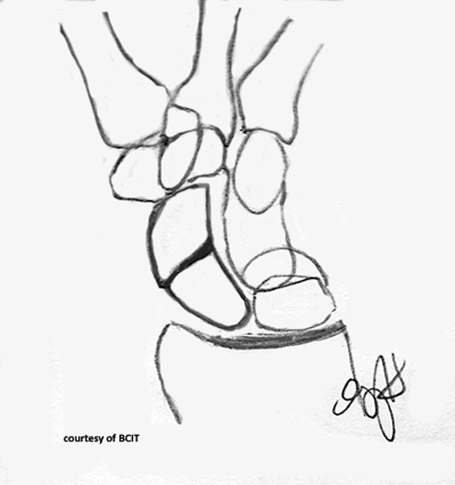 <p>Avascular necrosis due to poor blood supply.</p>