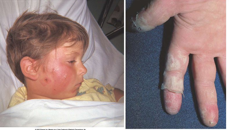 <p>Welke aandoening wordt hier afgebeeld?</p>